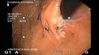 ENDOSCOPIC APPEARANCE OF LES VALVE AFTER ESOPHYX PROCEDUREwmv [upl. by Siblee]