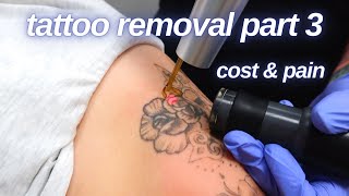 How Much Does Removal Cost Starting Session 2  Tattoo Removal Part 3 [upl. by Esidnak626]