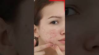 STOP Popping Those Pimples Before Its Too Late [upl. by Mavra]