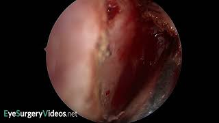 Posteriorly located frontal processlacrimal bone suture line [upl. by Novihs]