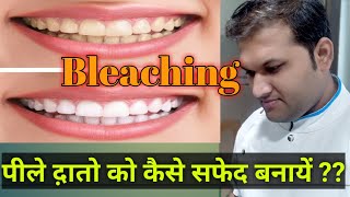 How To Whiten Your Yellow Teeth Dental Fluorosis Treatment  Whitening Tooth by Bleaching Paste [upl. by Paviour23]