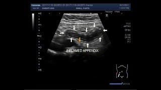 Ultrasound Video showing focusing of inflamed appendix [upl. by Fattal335]