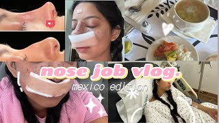 I GOT A RHINOPLASTY IN MEXICO [upl. by Ahseenyt]