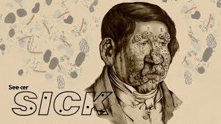 How Does Leprosy Damage the Human Body [upl. by Koch483]