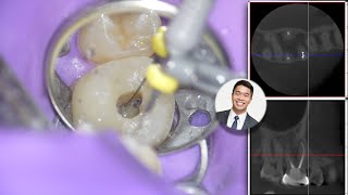 Endodontic Retreatment  Locating MB2 Canal [upl. by Airdni]