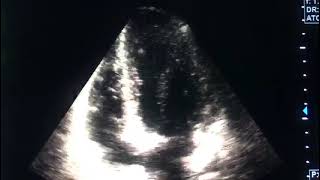 Myocarditis and echocardiographydrahmadmirdamadisiRSay4FU8O1HxWfD9 [upl. by Aime223]