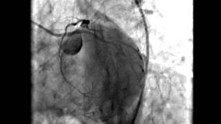 Coronary angiography cardiac catheterization video [upl. by Eirrok]