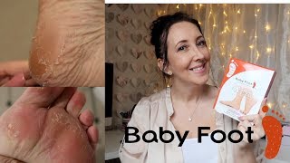 BABY FOOT PEEL REVIEW BEFORE amp AFTER  JANE ANN LOUISE [upl. by Gerrit]