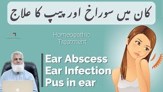 Ear Abscess amp Ear Infection Remedies  Pus in Ear  Otitis Media Treatment [upl. by Antonino]