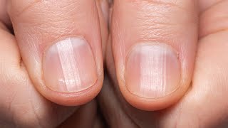 If You Have Ridges On Your Fingernails It Means This [upl. by Georgy]