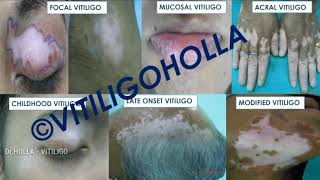 What is VITLIGO  Types of VITILIGO  by DrHOLLA  MELANOSITE [upl. by Nalor379]