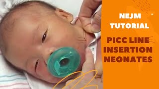 PICC Line placement in Neonates  NEJM Tutorial [upl. by Nelsen158]