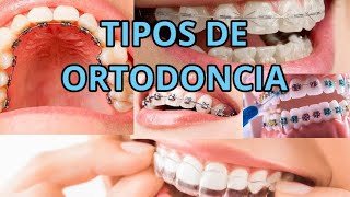 Tipos de Ortodoncia y Mi Opinion Sobre Cada Una De Ellas Dr Leonel Santos Ortodoncia Brackets [upl. by Endora94]