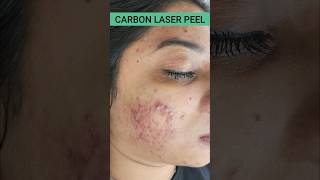 FASTEST ACNE RESULTSCARBON LASER PEEL DrArifMDDermatologist ACNE carbonpeel [upl. by Kirstin616]