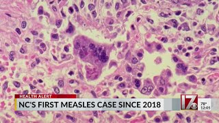 First measles case reported in NC since 2018 [upl. by Worth]