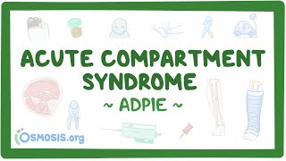 Compartment Syndrome Nursing Process [upl. by Anenahs]