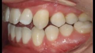 Crossbite Correction Treatment Timelapse [upl. by Prochoras502]