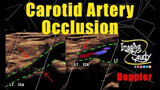 Carotid Artery Occlusion  Doppler  Ultrasound  Case 266 [upl. by Suoicerpal940]