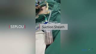 Percutaneous Nephrostomy Sheath Suction Sheath [upl. by Leunamnauj796]