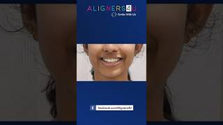 Invisible Aligners Journey  Clear Aligners Hyderabad  Braces  Smile Makeover  Aligners4U [upl. by Jonny424]