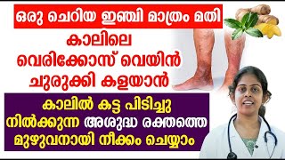 ഒരു ചെറിയ ഇഞ്ചി മാത്രം അതി കാലിലെ വെരിക്കോസ് വെയിൻ ചുരുക്കി കളയാൻ  Varicose veins Malayalam [upl. by Paske]