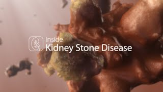 Medical Animation Kidney Stone Disease [upl. by Elleirol]