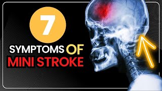 7 Symptoms of Mini Stroke  Transient Ischemic Attack  TIA  Signs [upl. by Vassaux150]