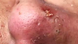 how to get rid of deep blackheads on nose 👃🐽🤢 [upl. by Rabka]