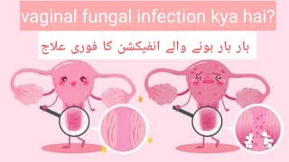 Aurton me Fungus ka infection candidiasis white discharge ka ilaj UrduHindi [upl. by Adnilemre84]