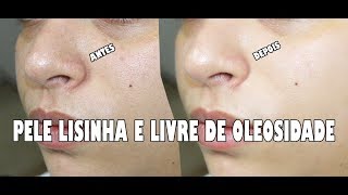 LIMPEZA DE PELE CASEIRA PARA PELE OLEOSA OU COM ACNE [upl. by Castro579]