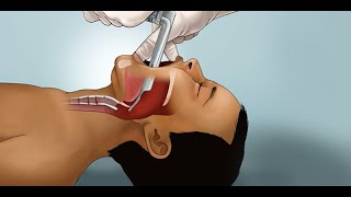 Pediatric Endotracheal Intubation by J Nagler et al  OPENPediatrics [upl. by Benedict131]