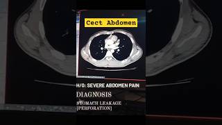 Cect Abdomen scan Perforation ctscan abdomen anatomy abdomenpain perforation leakage cect [upl. by Ahsyas]