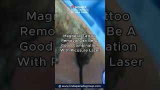 Magnetic tattoo removal with combination with a picosure laser for the body tattoo removal [upl. by Tom]