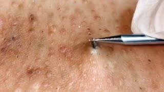 ingrown hair removal 😌 [upl. by Urana]