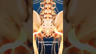 Degenerative Scoliosis Symptoms [upl. by Bannon984]