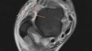 Anterior talofibular ligament tear and posterior tibial tendon tear [upl. by Lynd]