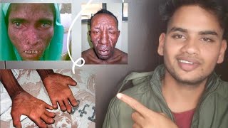 क्यू होता है LEPROSY  Leprosy Treatment  HINDI  leprosy BENATURALBEFIT [upl. by Adnomar470]