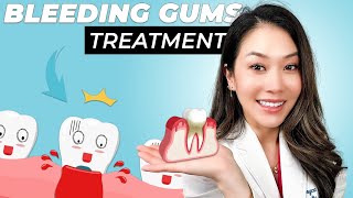 How To Treat Bleeding Gums At Home [upl. by Weinberg]