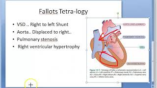 Pathology 424 a Fallots Tetralogy heart congenital disease Ventricular septal defect shunt TOF VSD [upl. by Azrim]