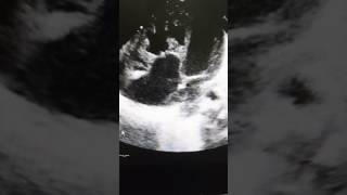 Case 24 echocardiography Ebsteins anomaly in 1 day old baby  born yesterday [upl. by Quintilla]