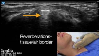 Cricothyroid membrane identification with ultrasound  transverse approach [upl. by Anawat]