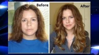 Mira Hair Oil Reviews  Before amp After Photos Must See [upl. by Zorana]