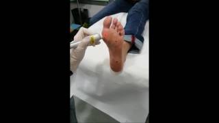 Trattamento Verruche con laser Fisioline Lumix CPS Podiatry [upl. by Eicnarf]