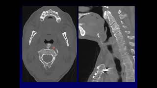 Quick case Submucosal pharyngeal mass [upl. by Lareena]