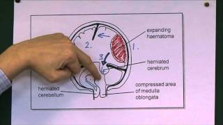 Head Injuries 9 Tentorial herniation [upl. by Sukcirdor]