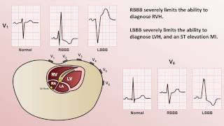 Intro to EKG Interpretation  Bundle Branch Blocks [upl. by Veron]