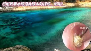 NO2023092301Earwax removalDead skin peeling死皮剥离和耳垢去除 [upl. by Ecinwahs]