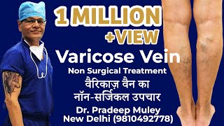 Varicose vein treatment procedure MicrowaveRFALaser Ablation Surgery [upl. by Lebasiairam37]