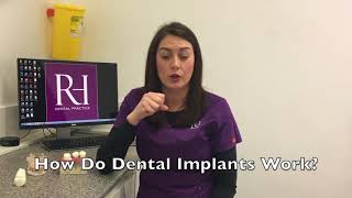 Dental Implant Information at Rock House Dental Practice [upl. by Palmira]