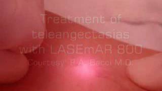 Phlebology  Flebolaser on Teleangectasias  Trattamento Flebolaser Teleangectasie  LASEmaR 800 [upl. by Lenahc]